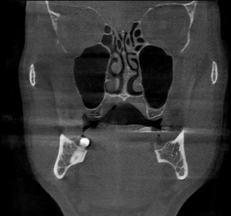 coronal slice of a J. Morita head phantom scan