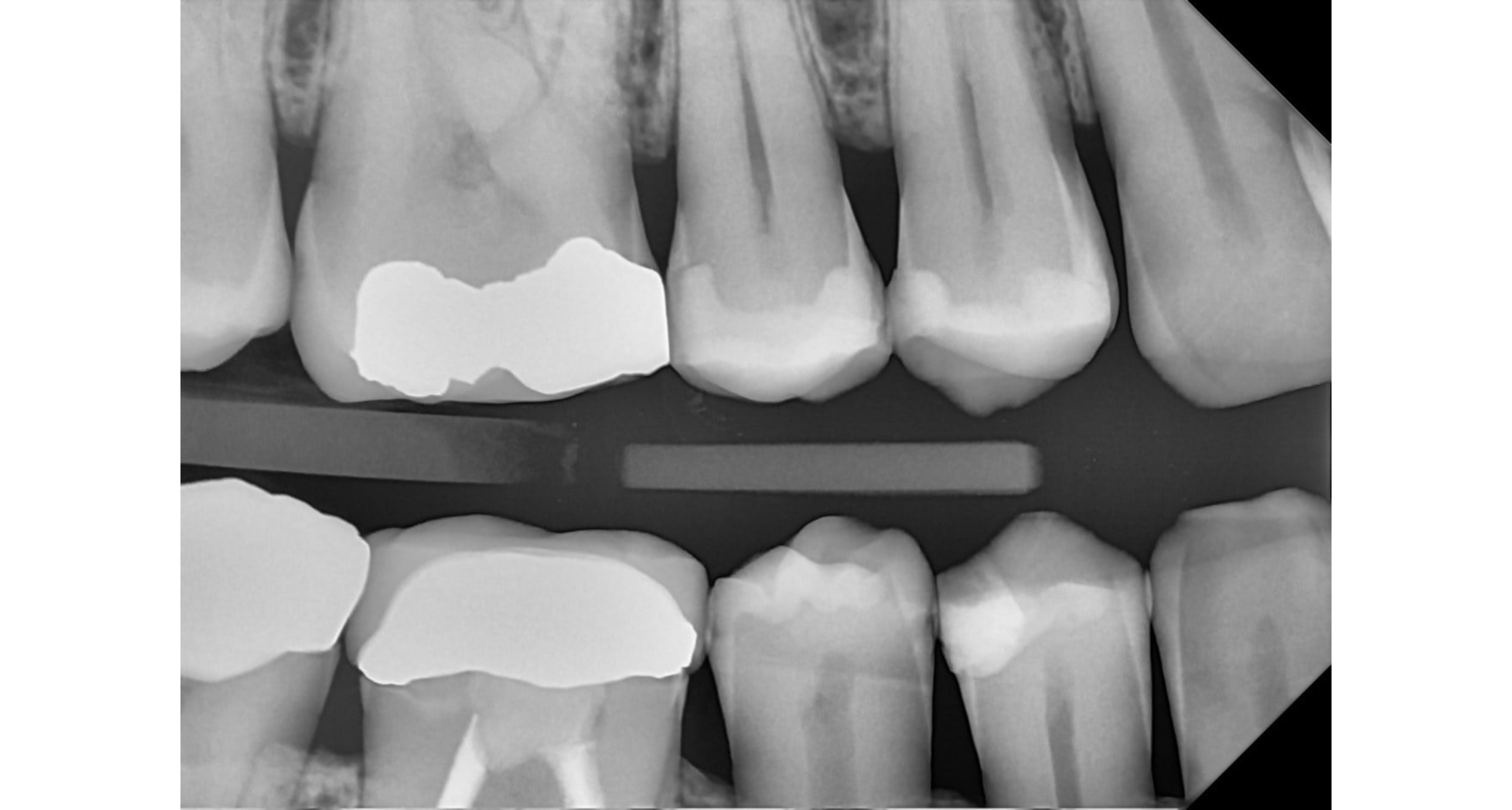 Intraoral dental radiograph